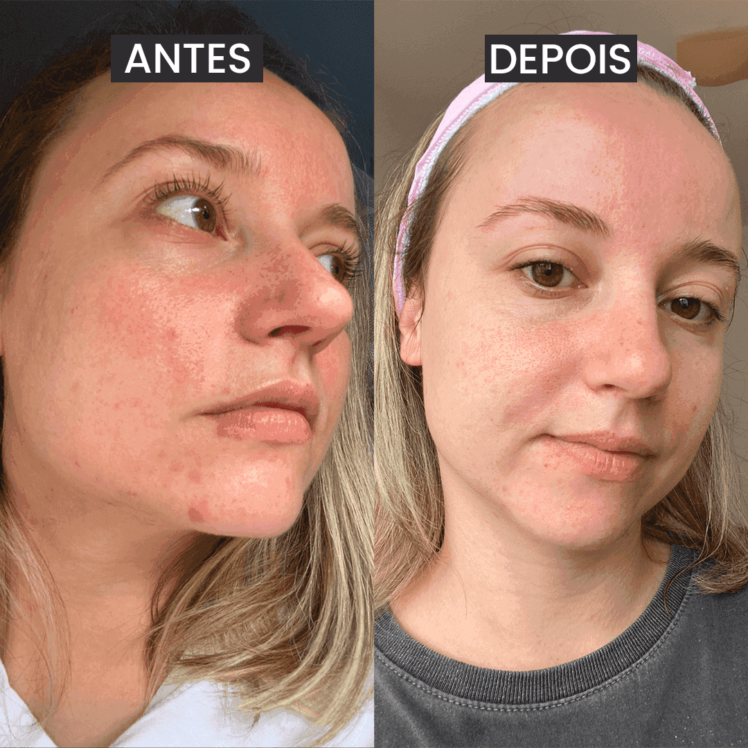 Máscara de Argila Rosa Antiacne