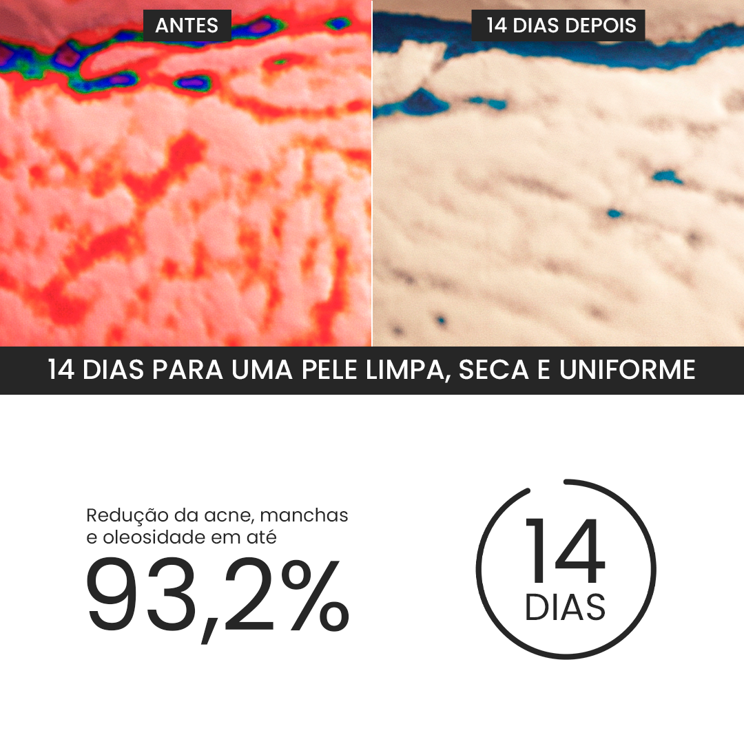 Kit SOS Acne Adulta | Edição Limitada