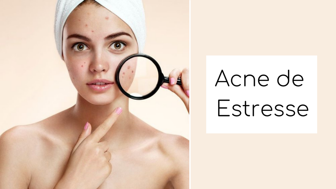 Acne de estresse? É possível?