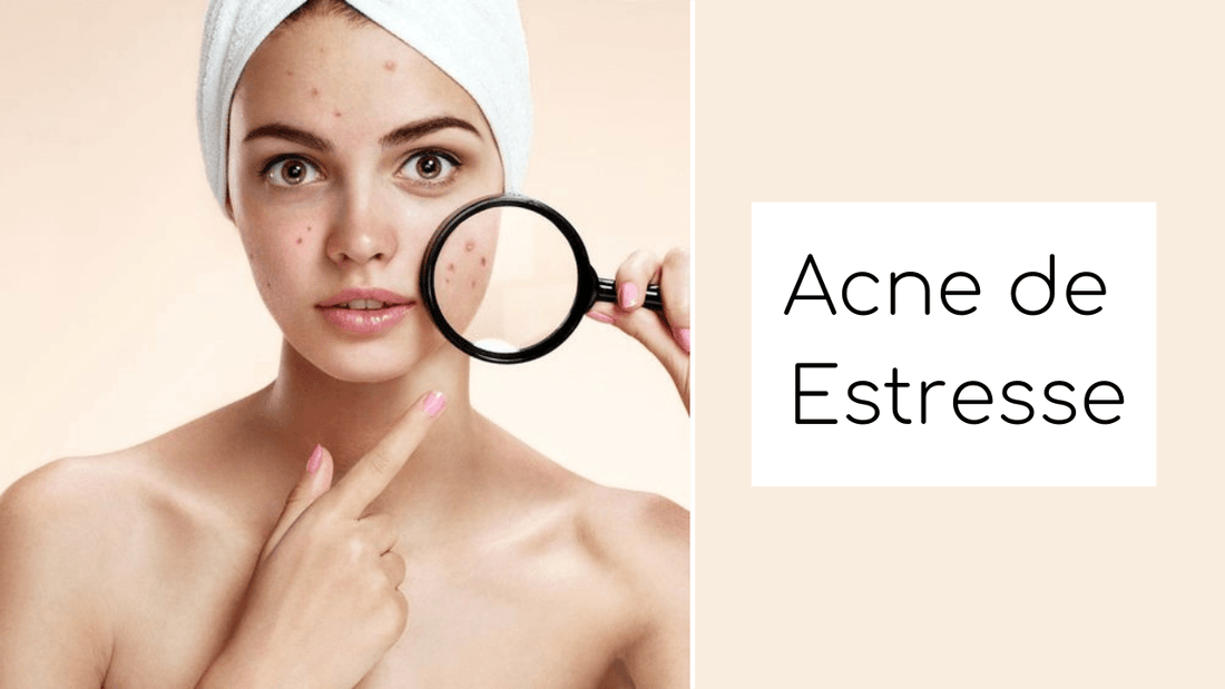 Acne de estresse? É possível? - PinkPerfect