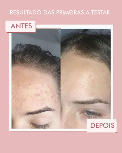 Máscara de Argila Rosa Antiacne + Sérum Vitamina C Ultra Concentrado