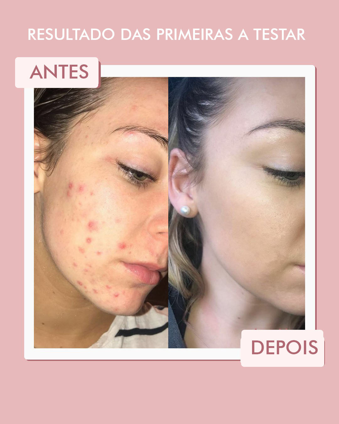 Máscara de Argila Rosa Antiacne + Sérum Vitamina C Ultra Concentrado