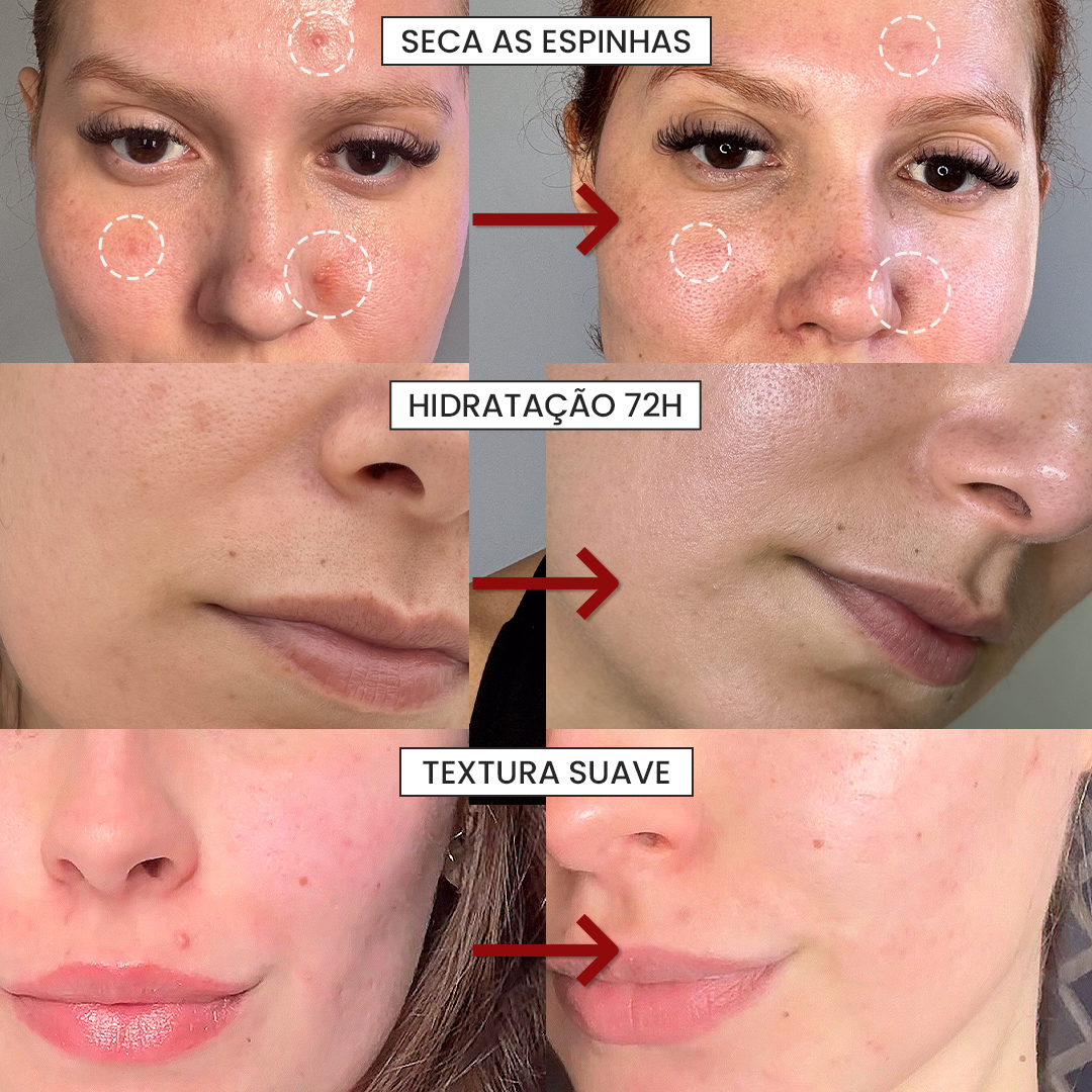 Lançamento: Kit Corretor e Secativo Antiacne