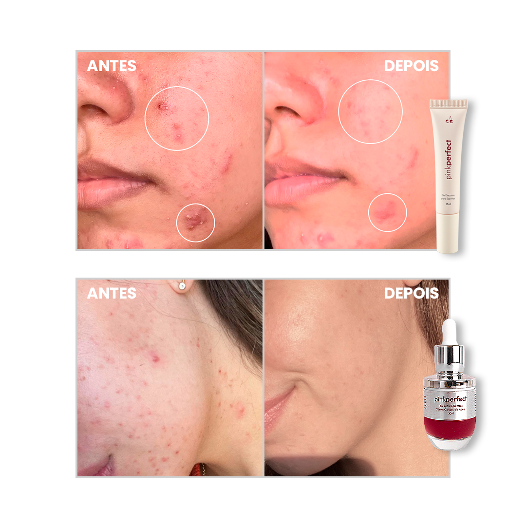 Duo S-Control + Gel Secativo