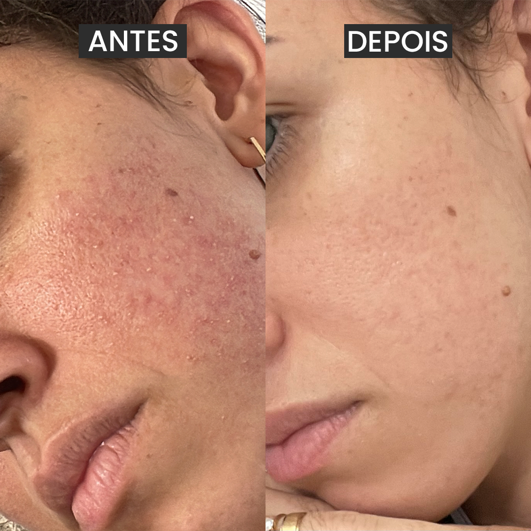 Kit 3 Passos contra a Acne Adulta + Brindes