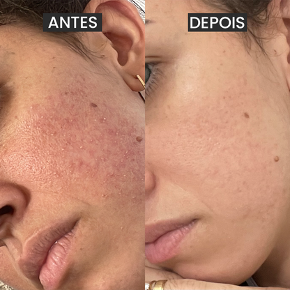 Kit 3 Passos contra a Acne Adulta + Brindes