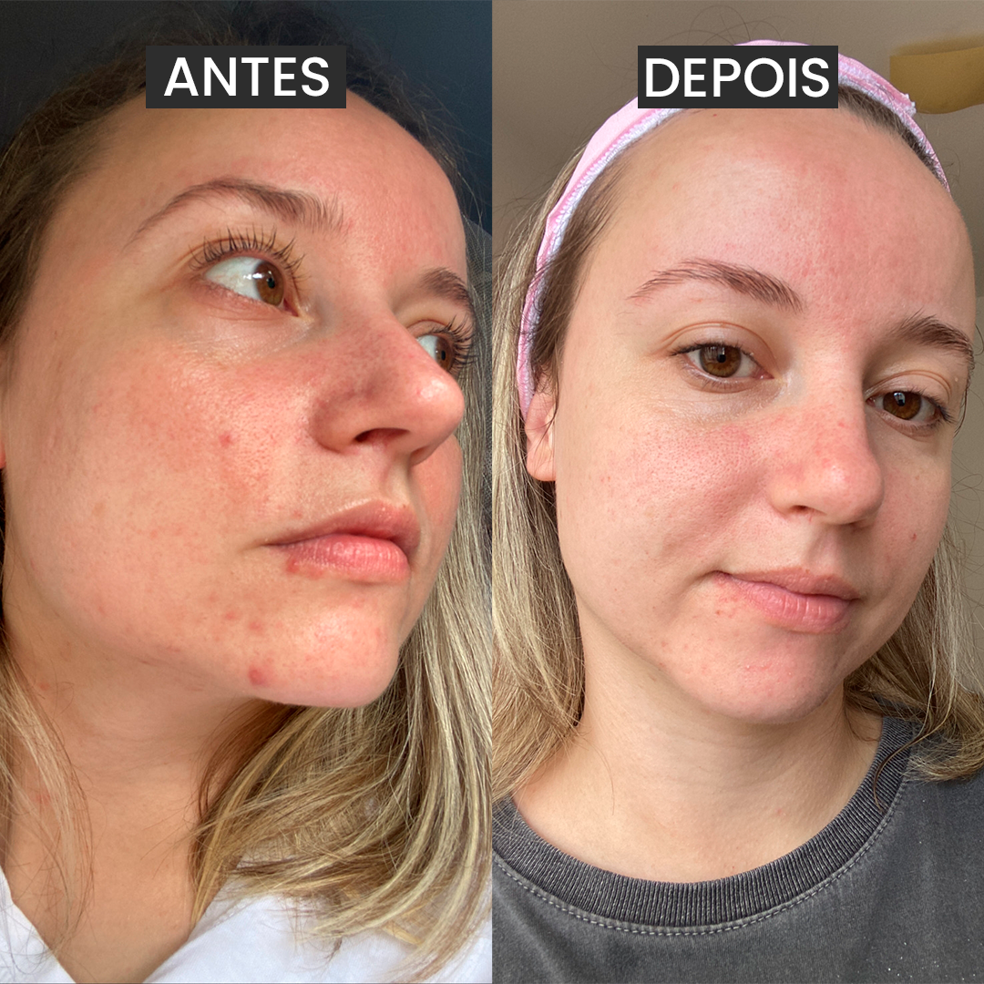 Máscara de Argila Rosa Antiacne (Mês do Consumidor)