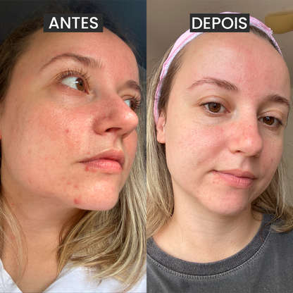 Máscara de Argila Rosa Antiacne (Mês do Consumidor)