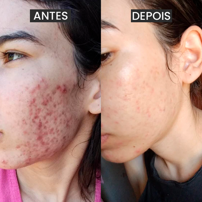 Kit 3 Passos contra a Acne Adulta + Brindes