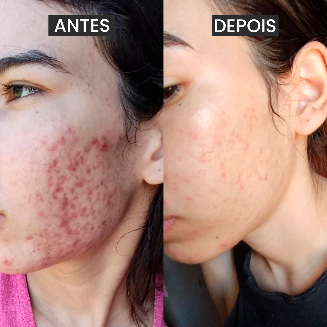 Kit 3 Passos contra a Acne Adulta - Exclusivo Influencer