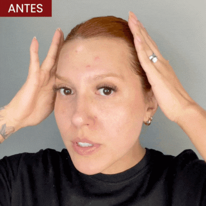 Solução S-Control | Sérum Corretor de Acne