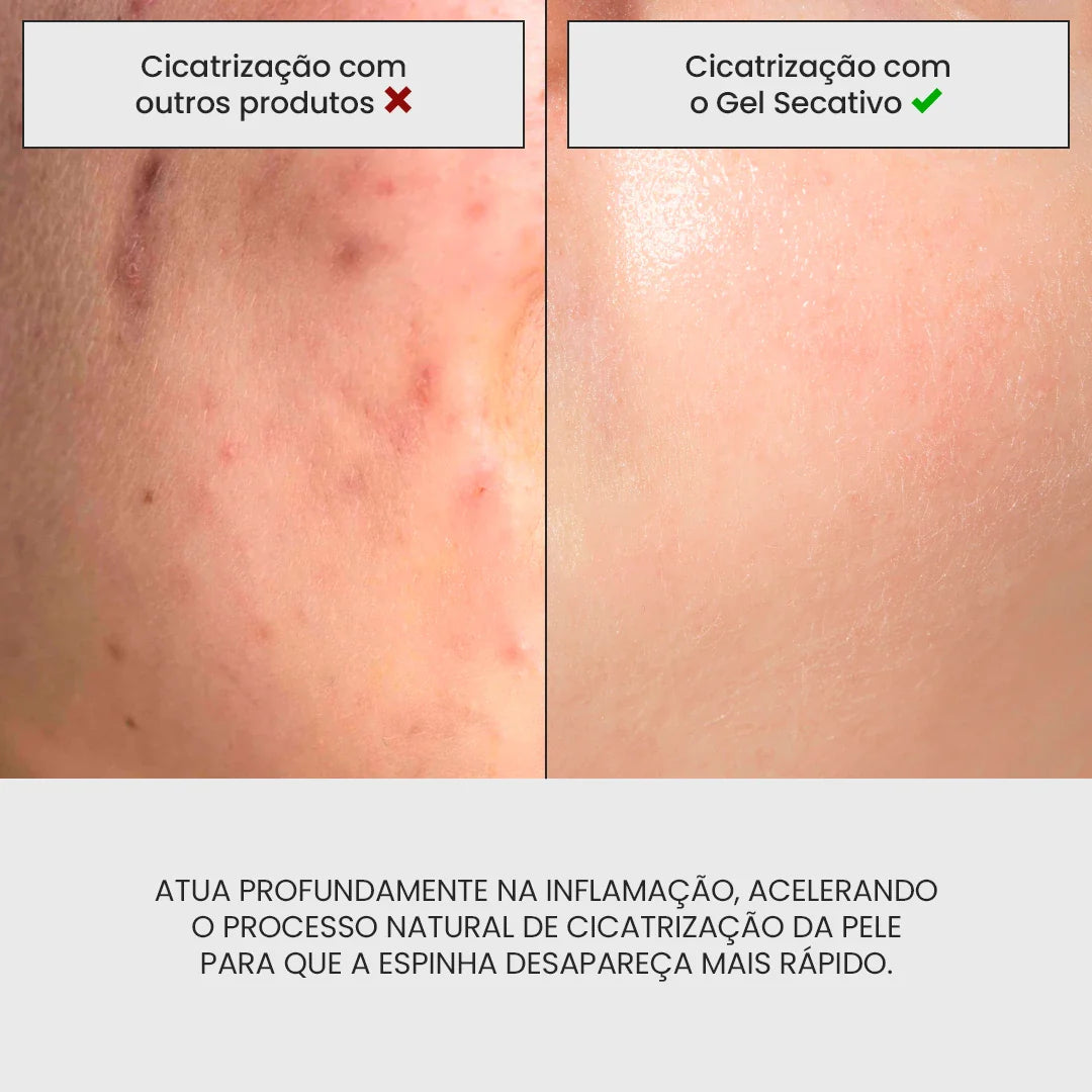 Gel Secativo para Espinhas | Película Invisível