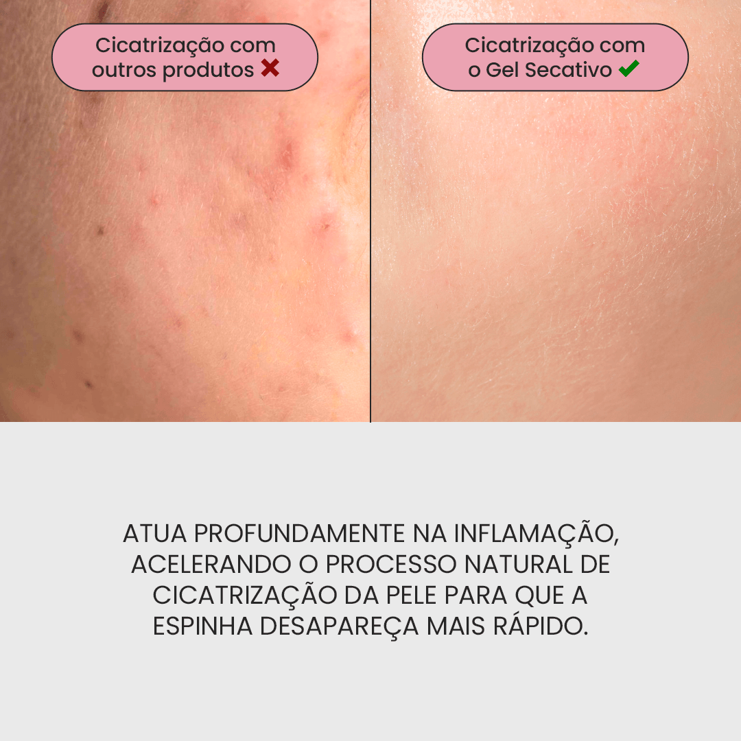 Kit SOS Acne Adulta
