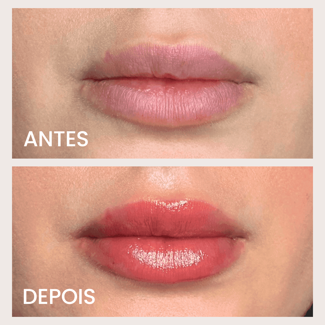 SOS NewLips Completo