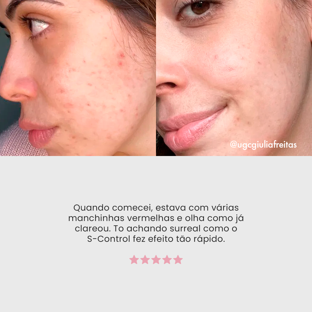 Solução S-Control | Sérum Corretor de Acne