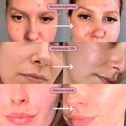 Solução S-Control | Sérum Corretor de Acne