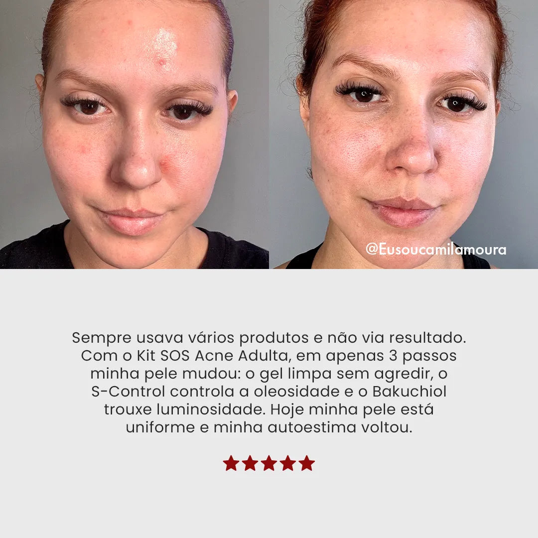 Lançamento: Kit SOS Acne Adulta | Edição Limitada