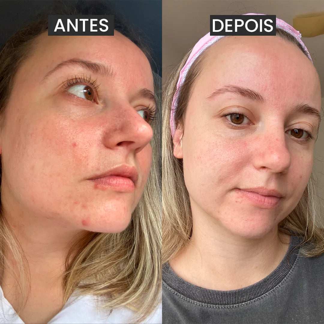 O Último Kit da Pink - 2025 Sem Acne