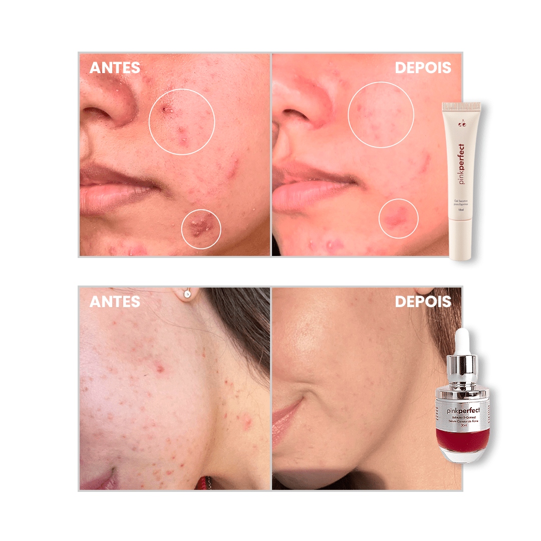 Duo S - Control + Gel Secativo - PinkPerfect