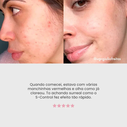 Duo S - Control + Gel Secativo - PinkPerfect