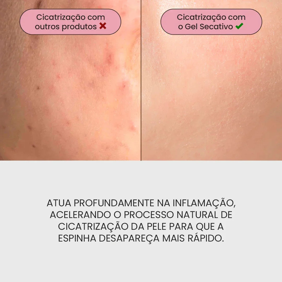 Duo S - Control + Gel Secativo - PinkPerfect