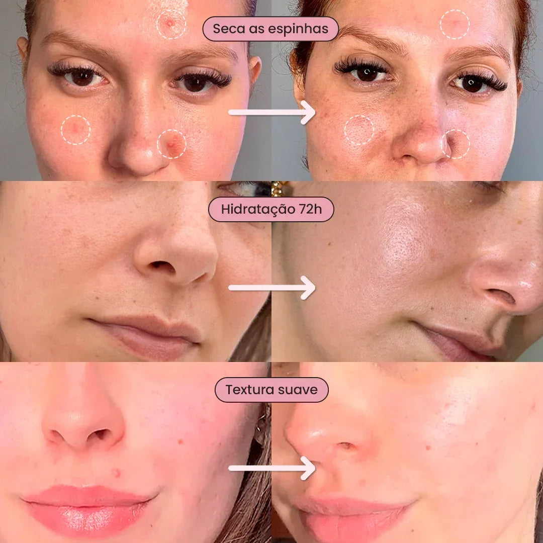 Duo S - Control + Gel Secativo - PinkPerfect