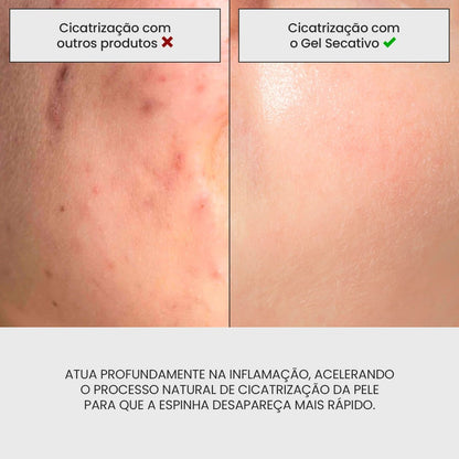 Gel Secativo para Espinhas | Película invisível + - PinkPerfect