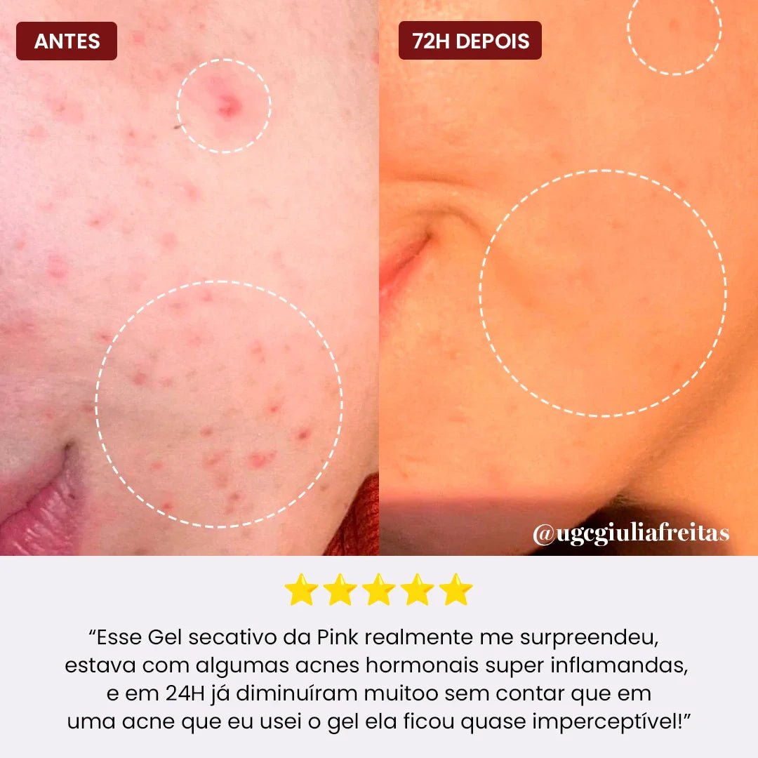 Gel Secativo para Espinhas | Película Invisível - PinkPerfect