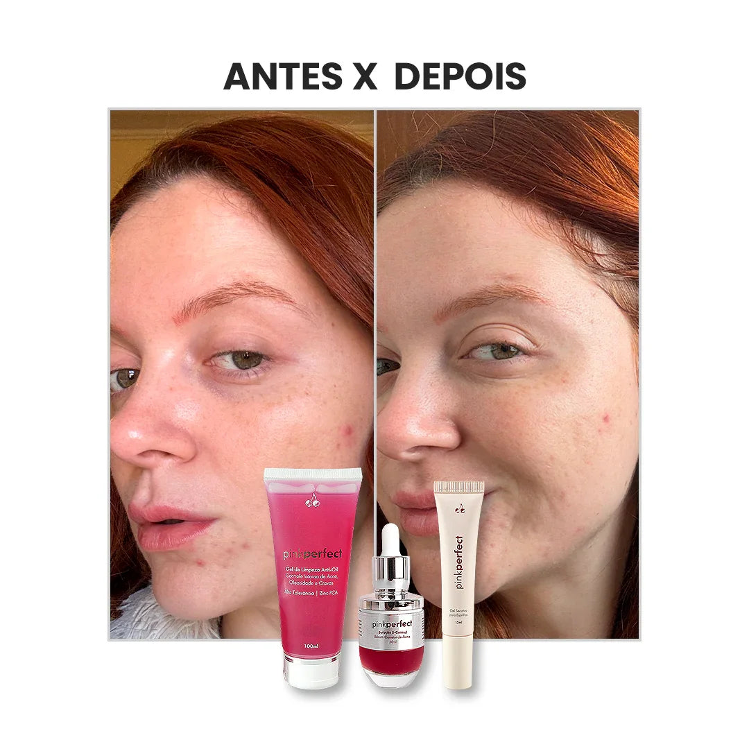 Kit Zero Acne - PinkPerfect