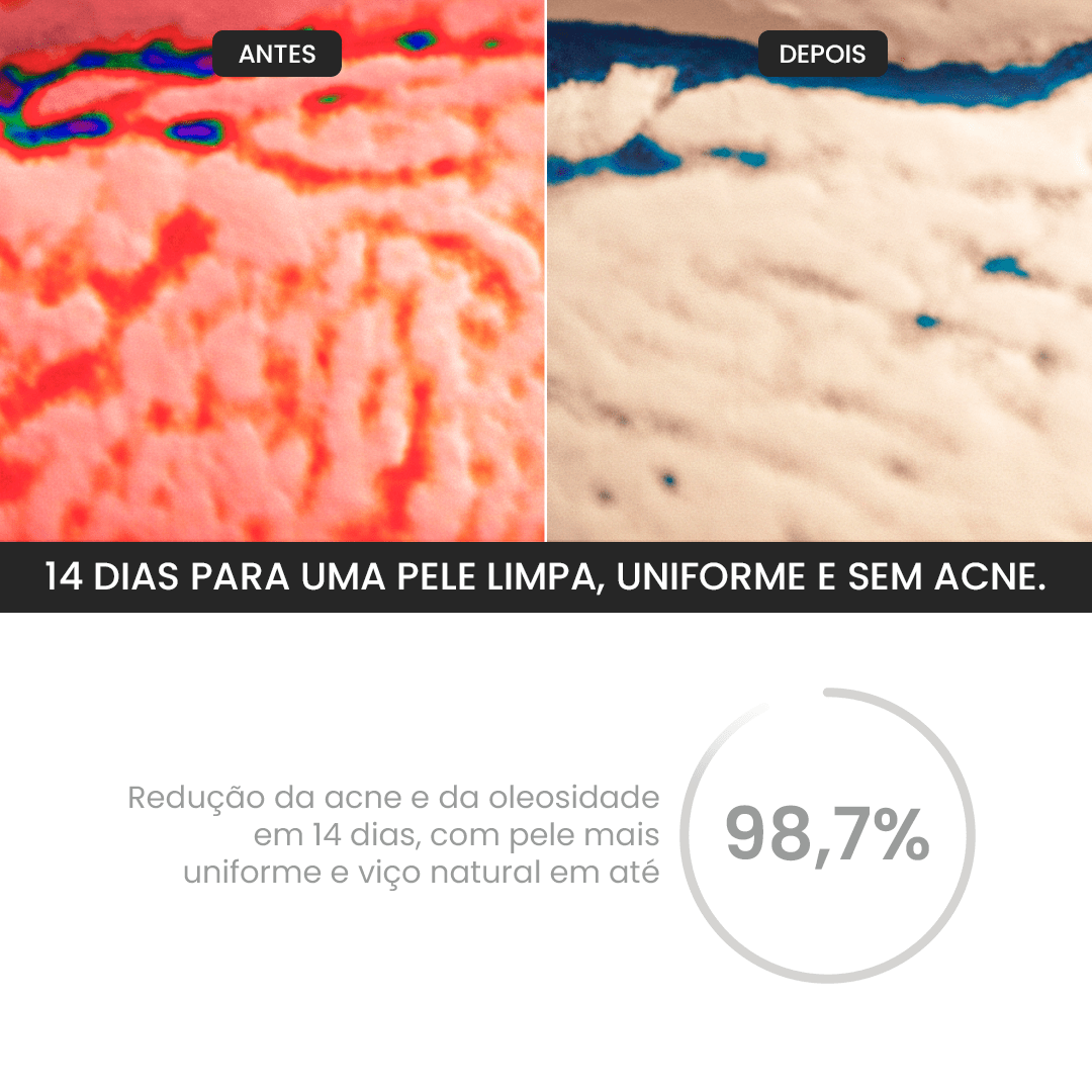 Kit Zero Acne - PinkPerfect
