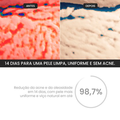 Kit Zero Acne - PinkPerfect
