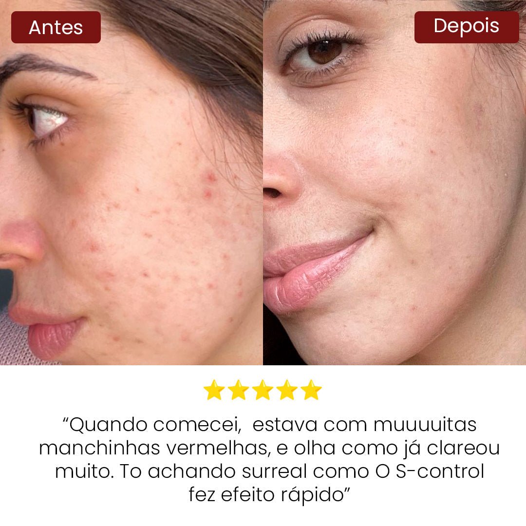 Solução S - Control | Sérum Corretor de Acne - PinkPerfect