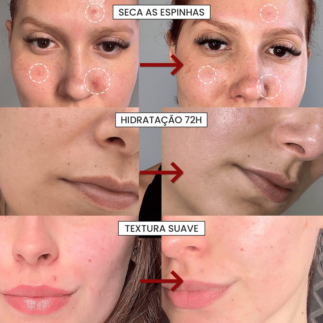Solução S - Control | Sérum Corretor de Acne - PinkPerfect