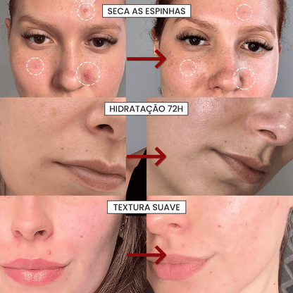 Solução S - Control | Sérum Corretor de Acne - PinkPerfect