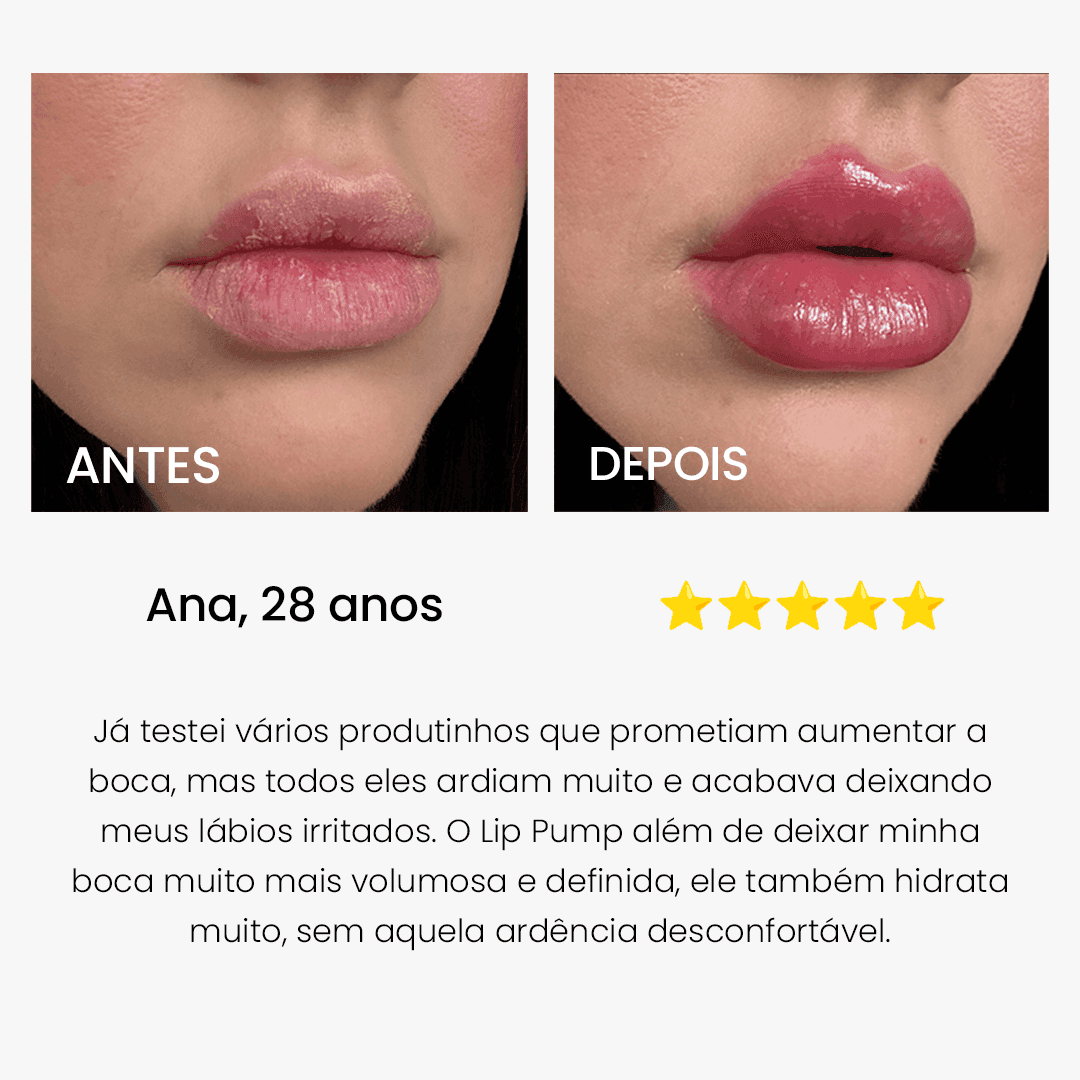 Antes e depois de lábios com produto volumizador; lábios mais volumosos e hidratados.